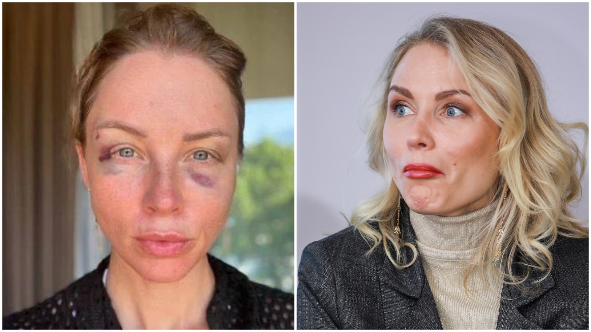 «Можно ли так упасть?»: Гордон намекнула на происхождение синяков на лице Дибровой